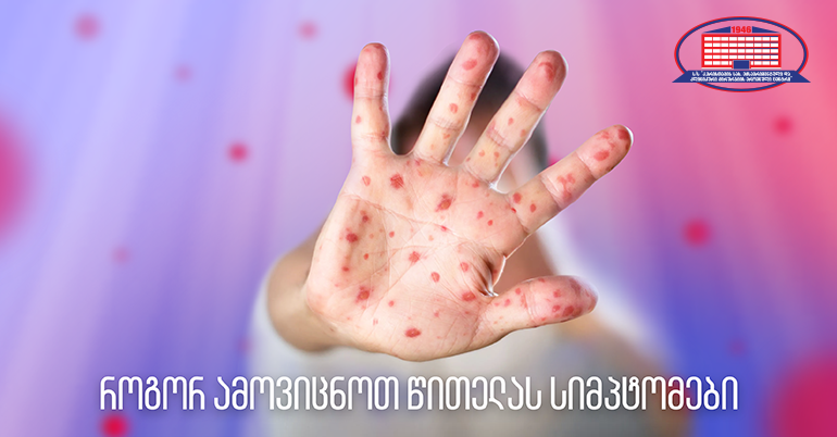 როგორ ამოვიცნოთ წითელა და რა გზით ვრცელდება მწვავე ვირუსული დაავადება?